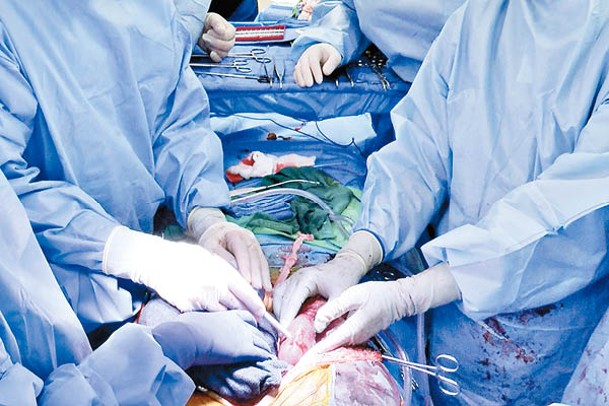 醫生移植豬腎至帕森斯體內。