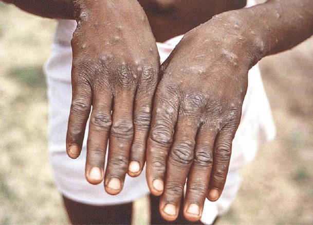 全球多地出現猴痘確診病例。