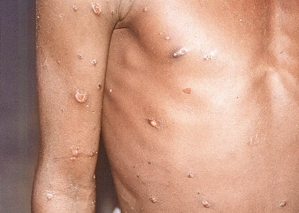 法國確診277宗猴痘  首現女性感染