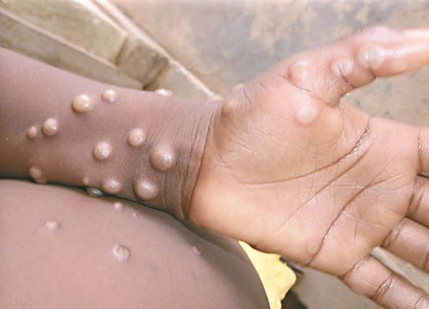 猴痘已在51個國家及地區傳播。