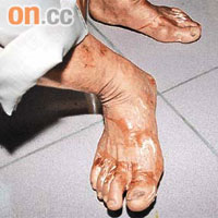 那瑪夏鄉村長劉金和的雙腳因細菌感染出現腫脹發黑。	（張偉御攝）