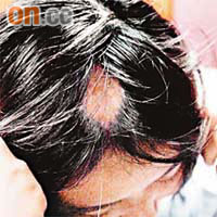 一名女子被燙傷頭皮後，寸髮不長。	（本報台北傳真）
