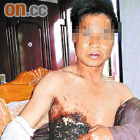 今年三月，廣東韶關市民林先生身上的手機突然爆炸起火，其身上多處地方被燒傷。