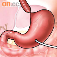 喉管插胃維生解構<BR>醫生將喉管直插福爾胃部，並將胃的頂部紮實，防止福爾將奶嘔出。