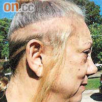 其中一名出面訴訟的女病人接受掃描後，一圈頭髮脫落，情況嚴重。