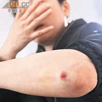 被三輪車拖行受傷的港婦展示手臂上的傷痕。（本報深圳傳真）