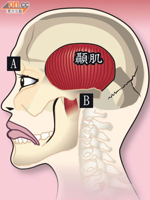 微笑移植手術<BR>A.癱瘓令左眼眼皮無法合上，嘴唇下垂<br>B.顎骨與顳肌的連接被斷開