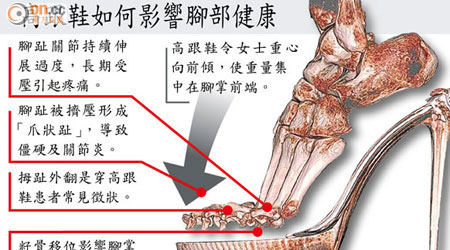 高跟鞋如何影響腳部健康