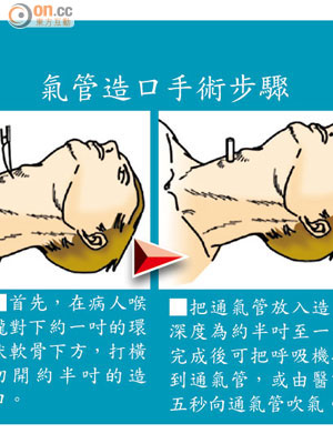 氣管造口手術步驟