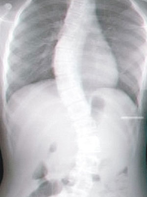 X光片顯示，貝里原患有脊柱側彎。（互聯網圖片）
