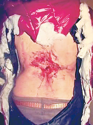 一名女網民展示背傷，聲稱是由警方投擲的閃光彈造成。（互聯網圖片）