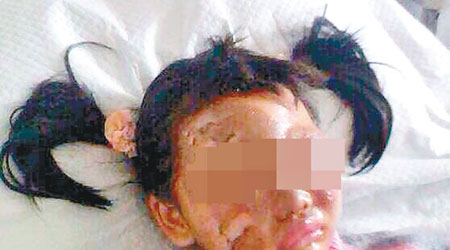 女童遭墮下的孔明燈燒傷臉部。（互聯網圖片）