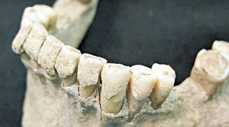 專家憑千年顎骨，發現古今人類所患的牙齒疾病皆由相同細菌造成。（互聯網圖片）