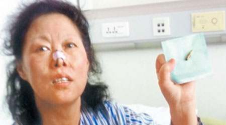 趙婦展示藏在鼻中多年的子彈。（互聯網圖片）