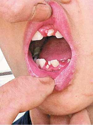 男童多顆牙齒被打掉。（互聯網圖片）