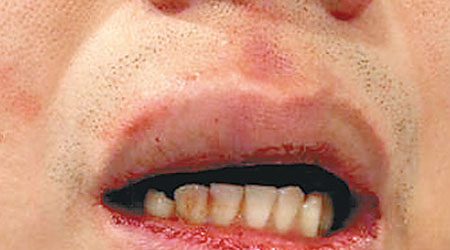 羅姓男子嘴部被麥當勞男服務員打傷。（互聯網圖片）