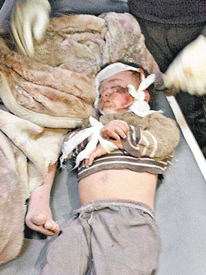 網上流傳空襲中傷者照片，一名小孩頭部受傷。（互聯網圖片）