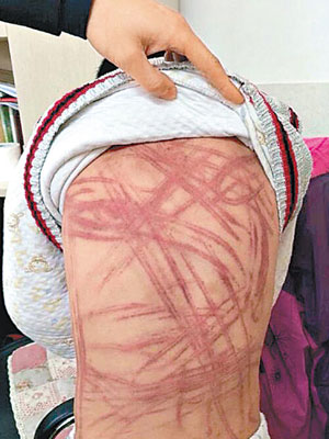 可見受虐小孩傷痕纍纍，僅是背部已有逾數十道藤條抽打的傷痕。（互聯網圖片）