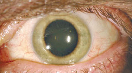 克羅澤的瞳孔由藍（左）變綠（右）。（互聯網圖片）