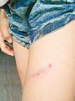 網傳其中一名小學生被校長打傷大腿的相片。（互聯網圖片）
