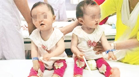 雙胞胎姐妹頭顱畸形，手腳似鴨蹼。（互聯網圖片）