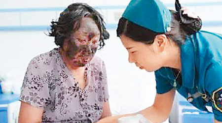 因莧菜過敏的老婦面部呈紫黑色，現正接受治療。（互聯網圖片）