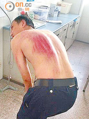 勇救長者的劉健生背部擦傷。