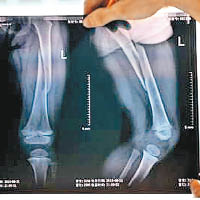 X光片顯示佳佳的左腿股骨骨折。（互聯網圖片）