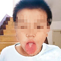 李先生兒子的舌頭遭氨水灼傷。