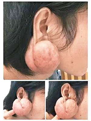 耳洞長出肉瘤，並不斷變大，近日更已經大如杧果般。