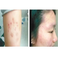 有學生出現皮膚炎（左、右圖）。（電視畫面）