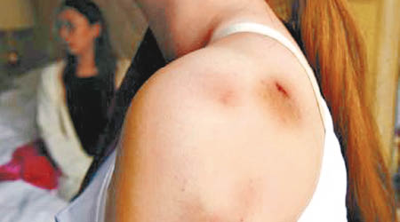 涉事女子全身多處瘀傷。（互聯網圖片）