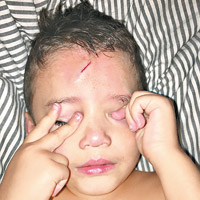 英國一名小男孩早前額頭撞到床角受傷，留下一條顯眼的疤痕。（互聯網圖片）