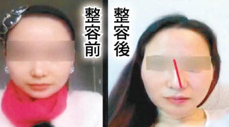 女事主隆鼻後鼻子明顯傾斜。（互聯網圖片）