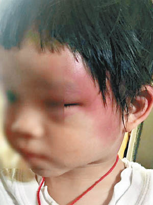 疑被虐打的女童面部有瘀傷。（中時電子報圖片）