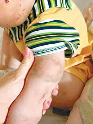 男嬰手部布滿傷痕。（互聯網圖片）