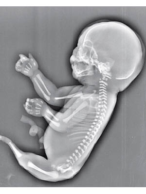 胎兒沒有雙腿，只有一條「尾巴」。（互聯網圖片）