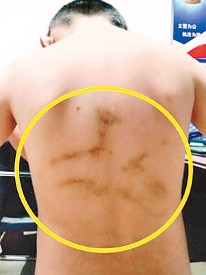 男童背部留「衣架形」傷痕（黃圈示）。