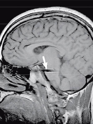 X光片顯示男子腦部插有折斷的筷子。