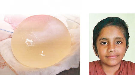 女童（右圖）的腦部長出包蟲囊腫（左圖）。