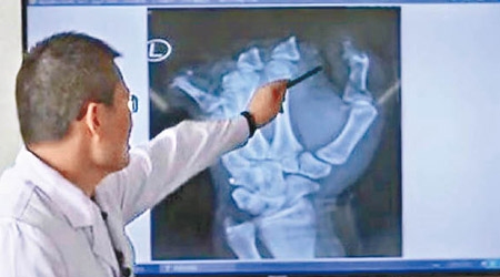 醫生指小童的手指骨出現斷折。（互聯網圖片）