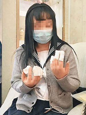 張女因美甲後患上手膿性指頭炎。（互聯網圖片）
