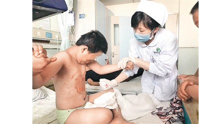 男童胸腹遭燒傷，傷口出現感染。（互聯網圖片）