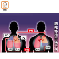 肺部移植手術示例