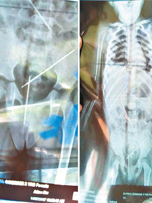 X光片顯示女童身體遭人插入長針。