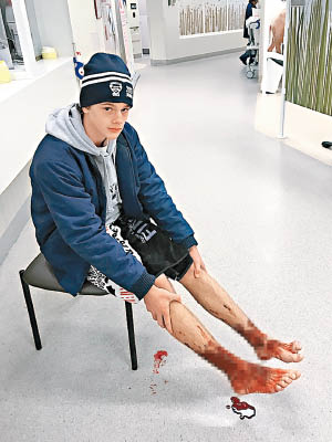森姆雙腳不斷流血。（互聯網圖片）