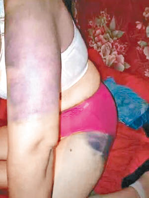 常婦的手臂及大腿多處瘀腫。