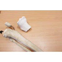 小腿脛骨由3D打印技術製成。（電視畫面）