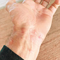 格雷戈里的手部出現紅腫。（互聯網圖片）