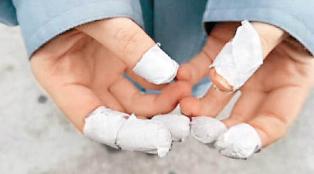有實習學生做到手指頭磨損。（互聯網圖片）